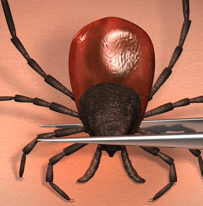 tick removal